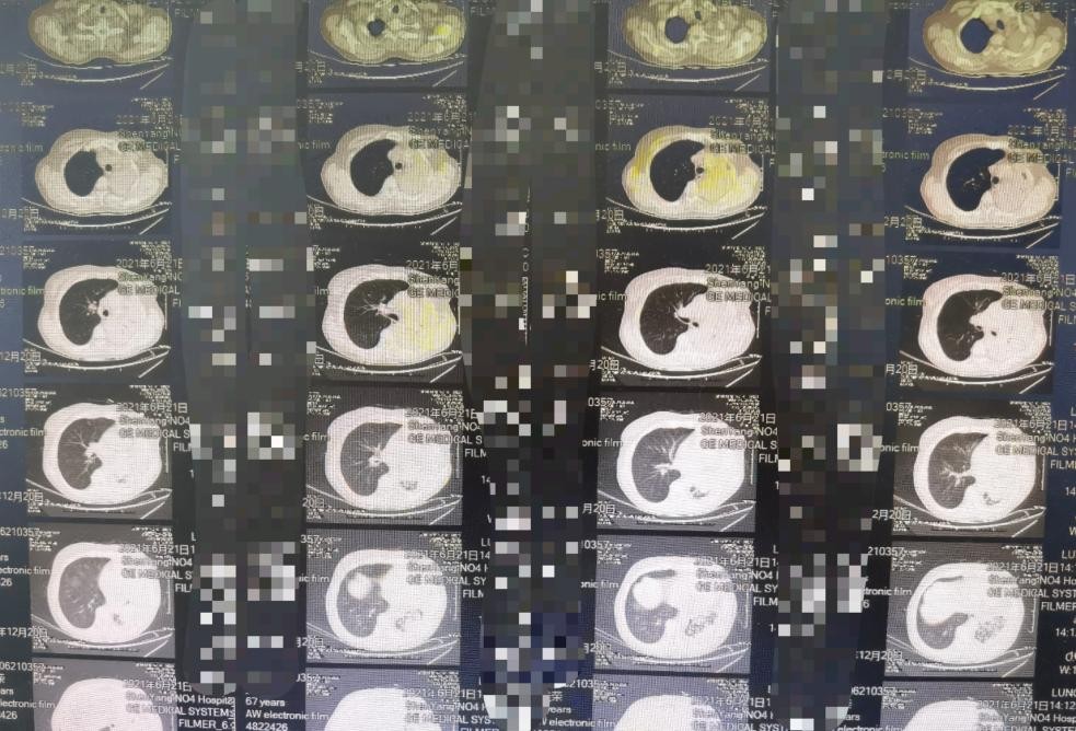 沈阳市第四人民医院完成首例硬质支气管镜诊疗